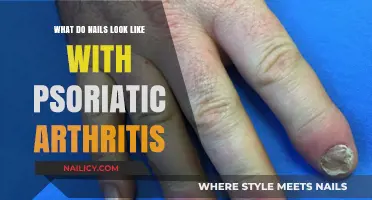 Psoriatic Arthritis Nail Changes: Identifying Symptoms and Appearance