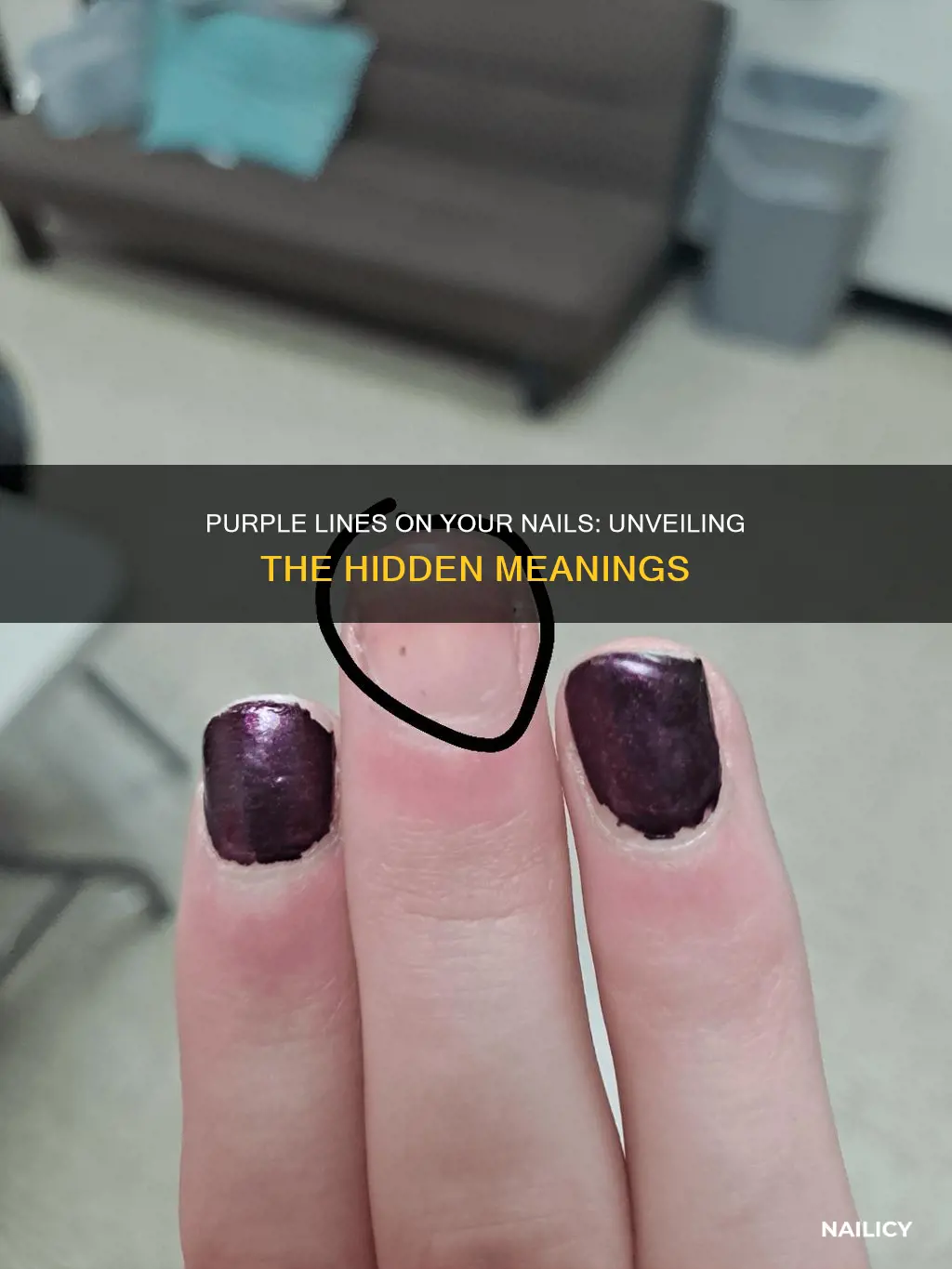 what do purple lines on your nails mean