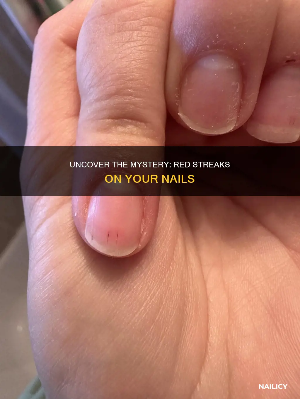 what do red streaks on the nail beds mean