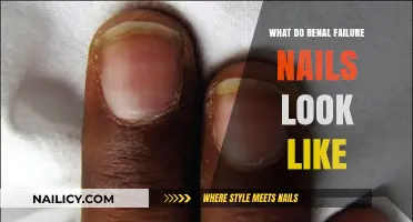 Identifying Renal Failure Through Nail Changes: A Visual Guide