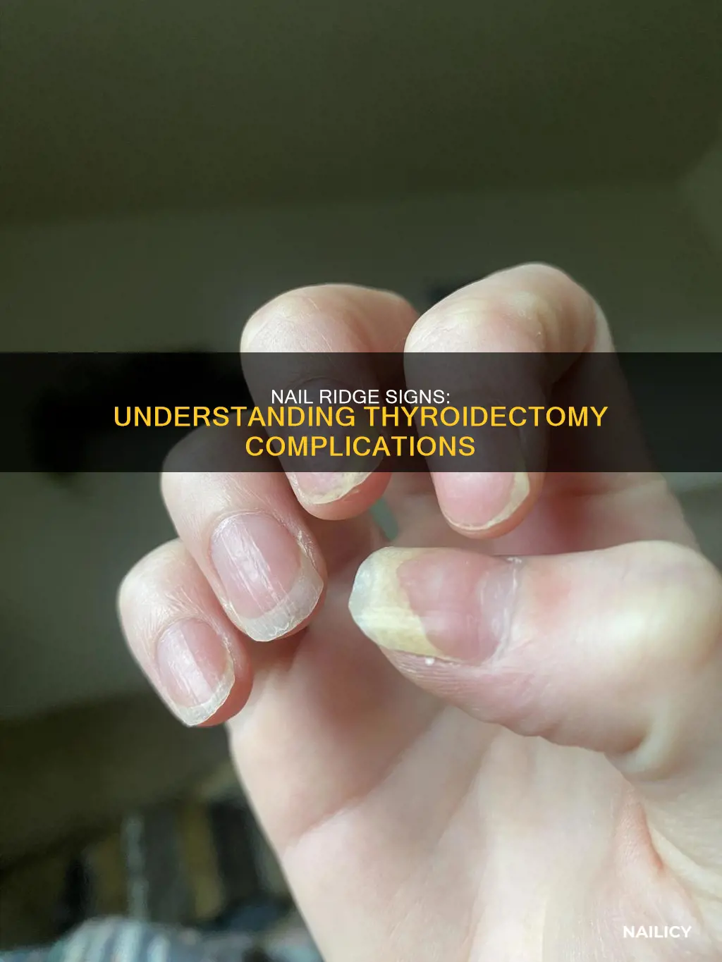 what do ridges in my nails after thyroidectomy mean