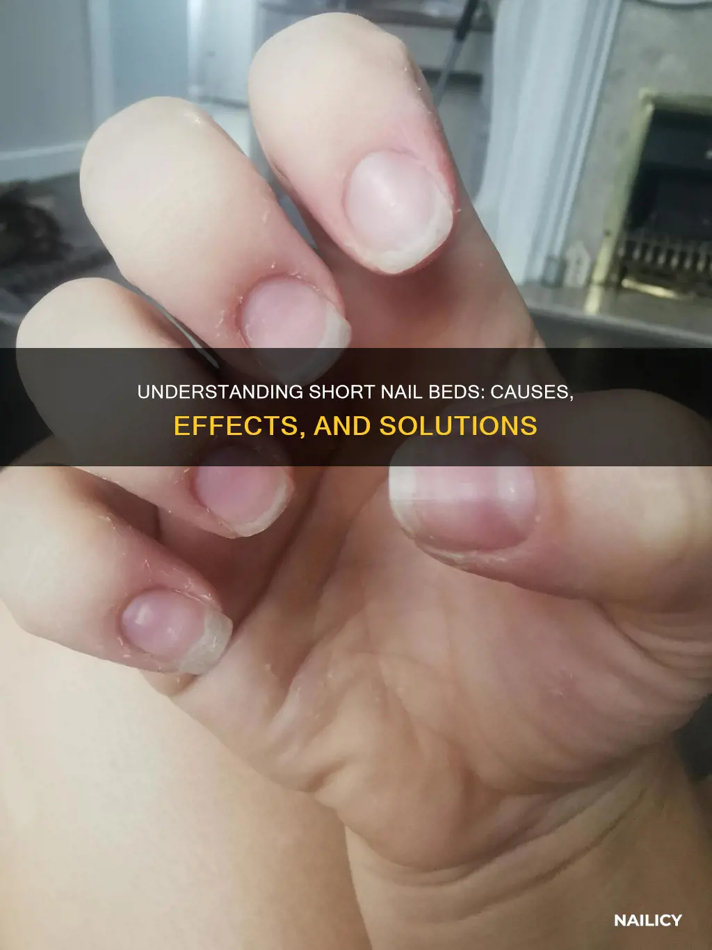 what do short nail beds mean