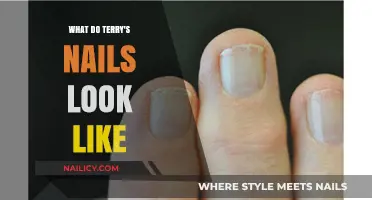 Terry's Nails Appearance: Identifying Characteristics and Health Implications Explained