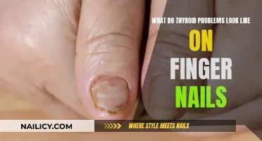 Unraveling Thyroid Issues: How Your Nails Can Tell the Tale