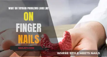 Thyroid Problems: Finger Nails as Health Clues
