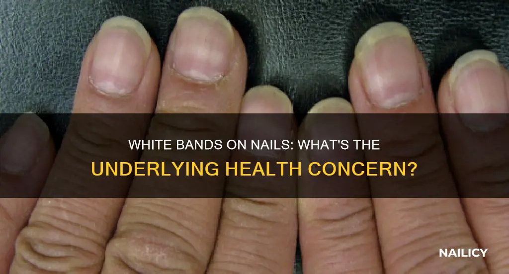 what do white bands on nails mean