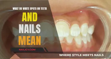 Teeth and Nails: White Spots, What's the Deal?