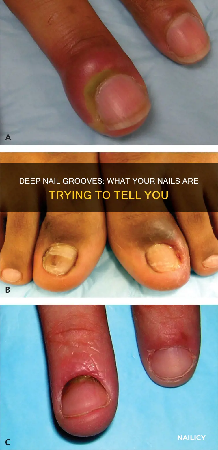 what doe deep grooves in nails mean