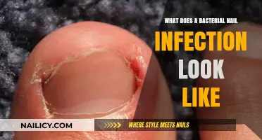Identifying Bacterial Nail Infections: Symptoms, Appearance, and Treatment Options