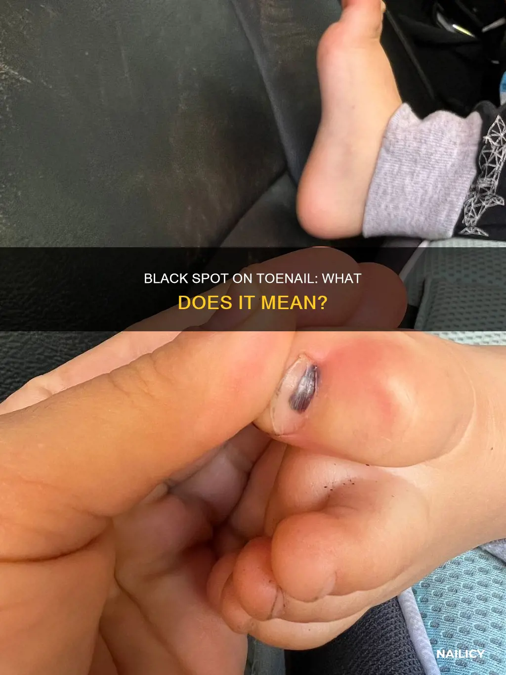 what does a black spot on your toe nail mean