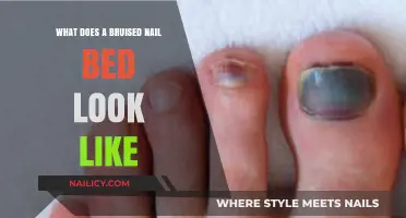 Bruised Nail Bed: Appearance, Causes, and Healing Process Explained