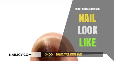 Identifying a Bruised Nail: Appearance, Causes, and Healing Process