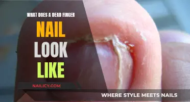 Dead Finger Nail: Appearance, Causes, and Treatment Options