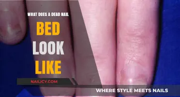 Identifying a Dead Nail Bed: Symptoms, Appearance, and Causes Explained