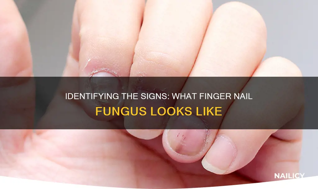 what does a finger nail fungus look like