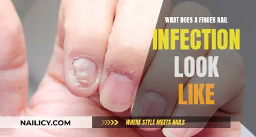 Identifying the Signs: How to Spot a Finger Nail Infection