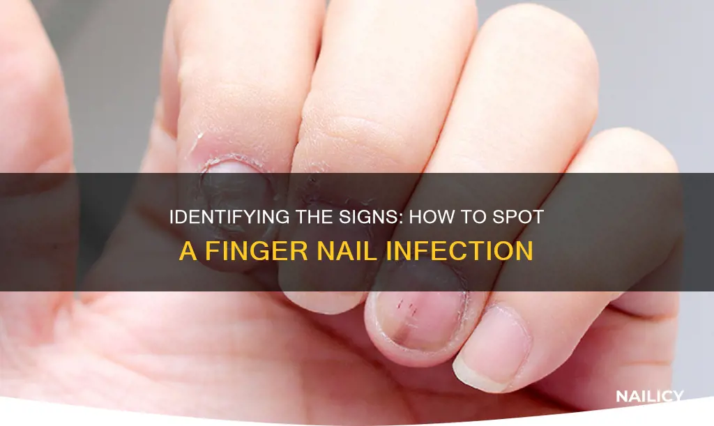 what does a finger nail infection look like