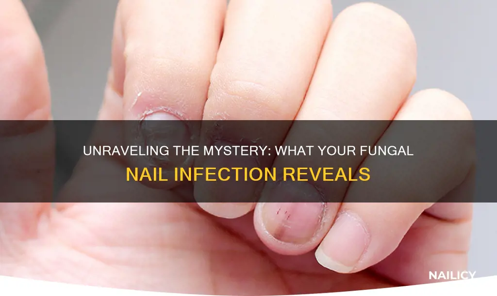 what does a fungal infection on nails and toes mean