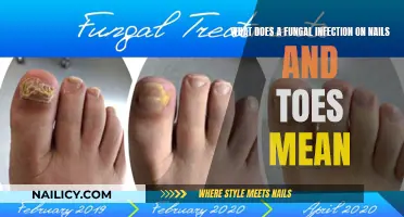 Fungal Infections: Nails, Toes, and What They Mean