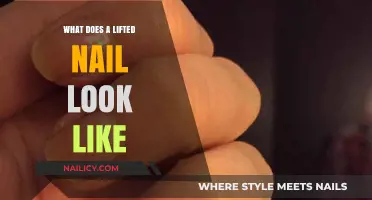 Understanding Lifted Nails: Appearance, Causes, and Treatment Options Explained