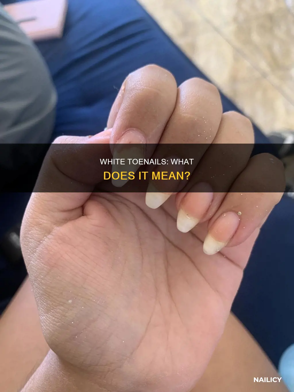 what does all white toe nails mean