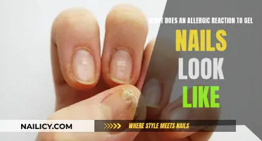 Gel Nails: Allergic Reactions and You