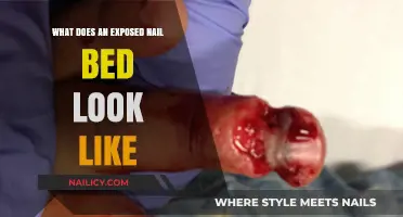Exposed Nail Bed Appearance: What to Expect and How to Treat It