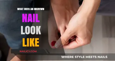 Identifying Ingrown Nails: Visual Signs and Symptoms Explained