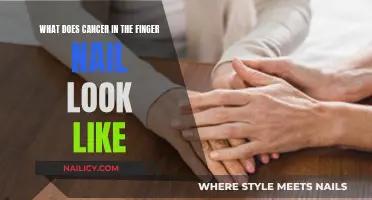 Recognizing Cancer in Fingernails: What to Look For