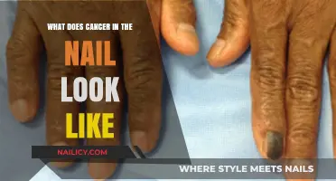 Recognizing Nail Cancer: Symptoms, Appearance, and Early Detection Signs