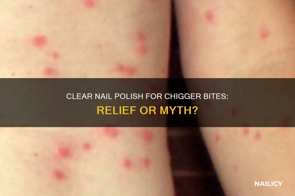 what does clear nail polish do to chigger bites