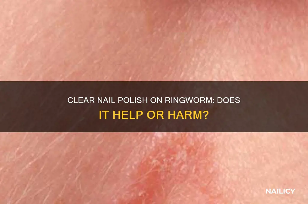 what does clear nail polish do to ringworm