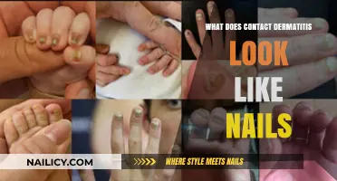 Contact Dermatitis on Nails: Symptoms, Appearance, and Treatment Options