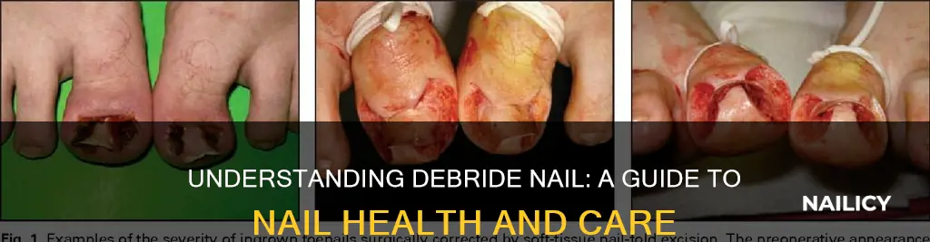 what does debride nail mean