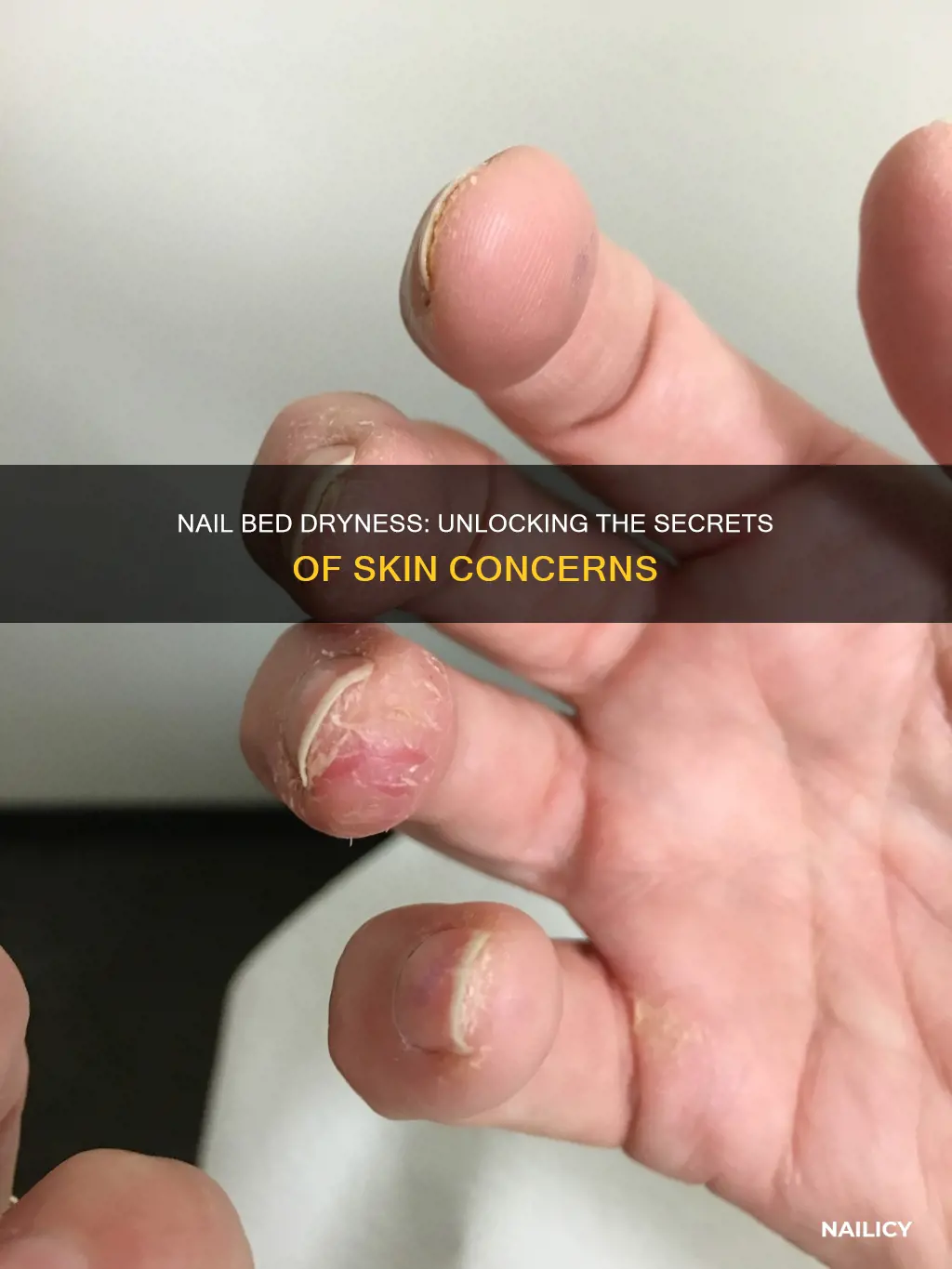 what does dry skin around nails mean