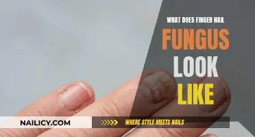 Recognizing Fingernail Fungus: What to Look For