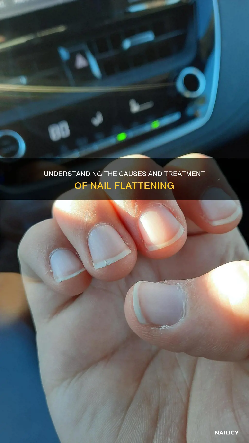 what does flattening of the nails mean