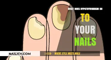 Hypothyroidism and Nail Health: Symptoms, Changes, and Care Tips
