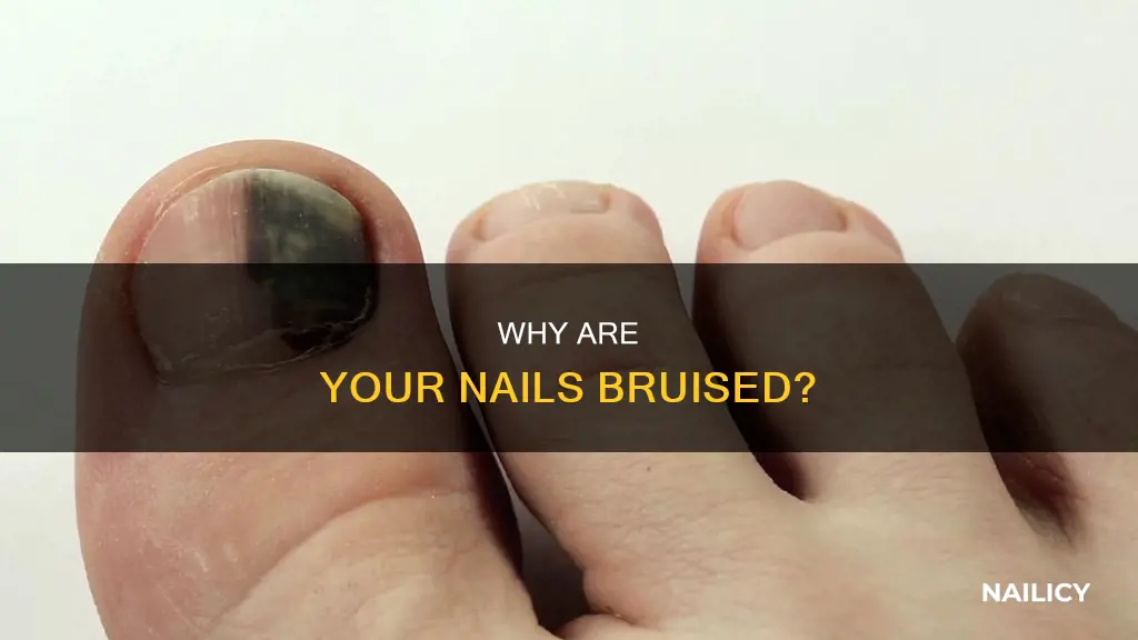 what does it mean if you nail underneath is bruised