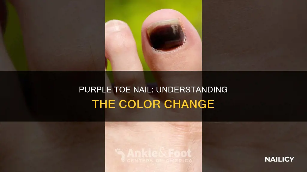 what does it mean if your toe nail is purple