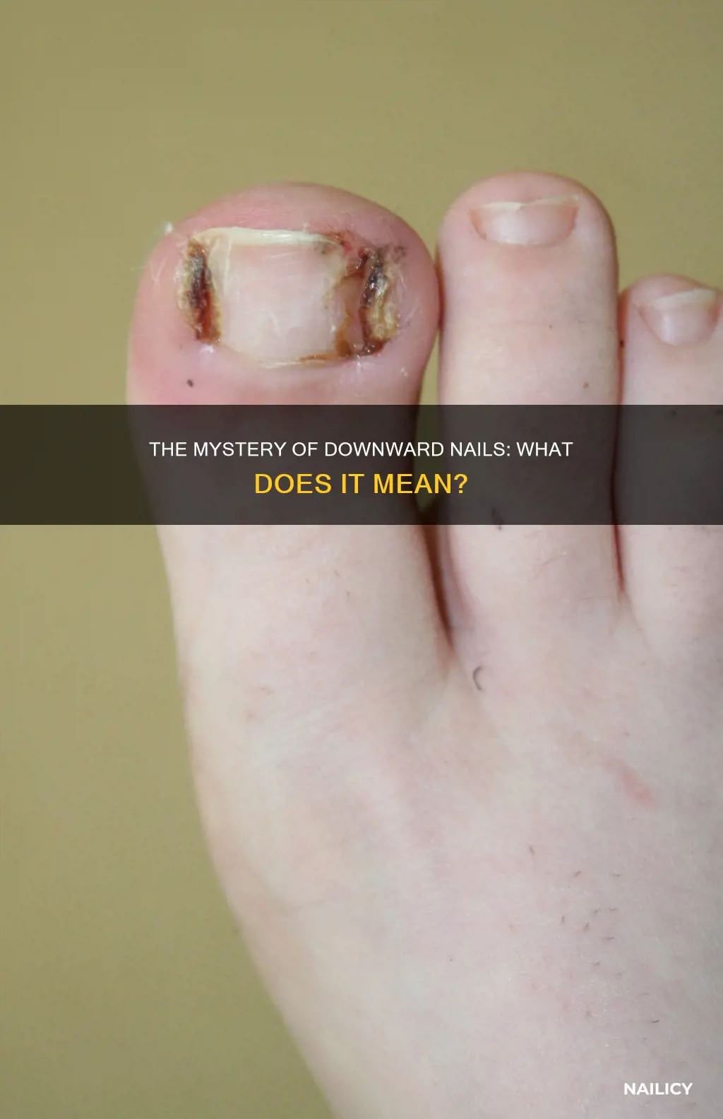 what does it mean when a person nails grow downwards