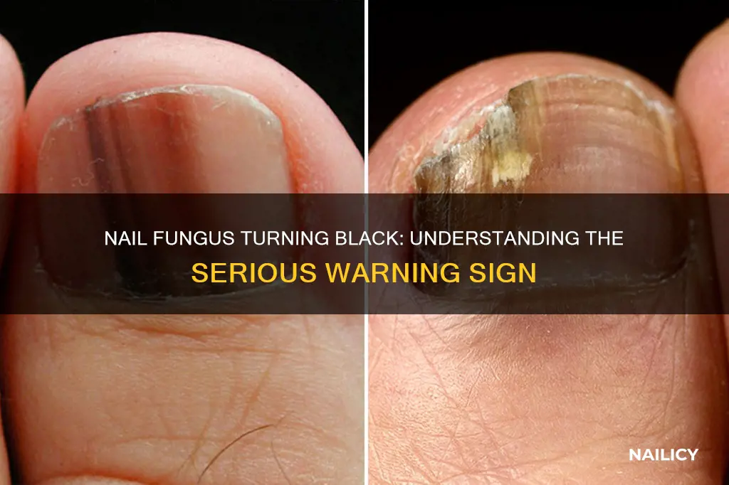 what does it mean when nail fungus turns black