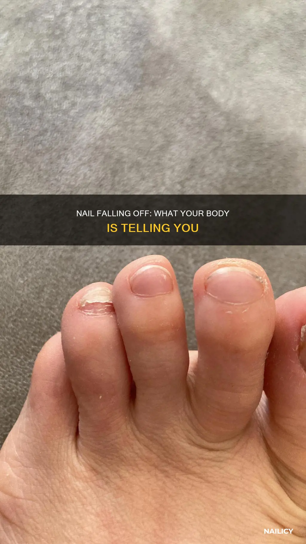what does it mean when yojr nail falls off