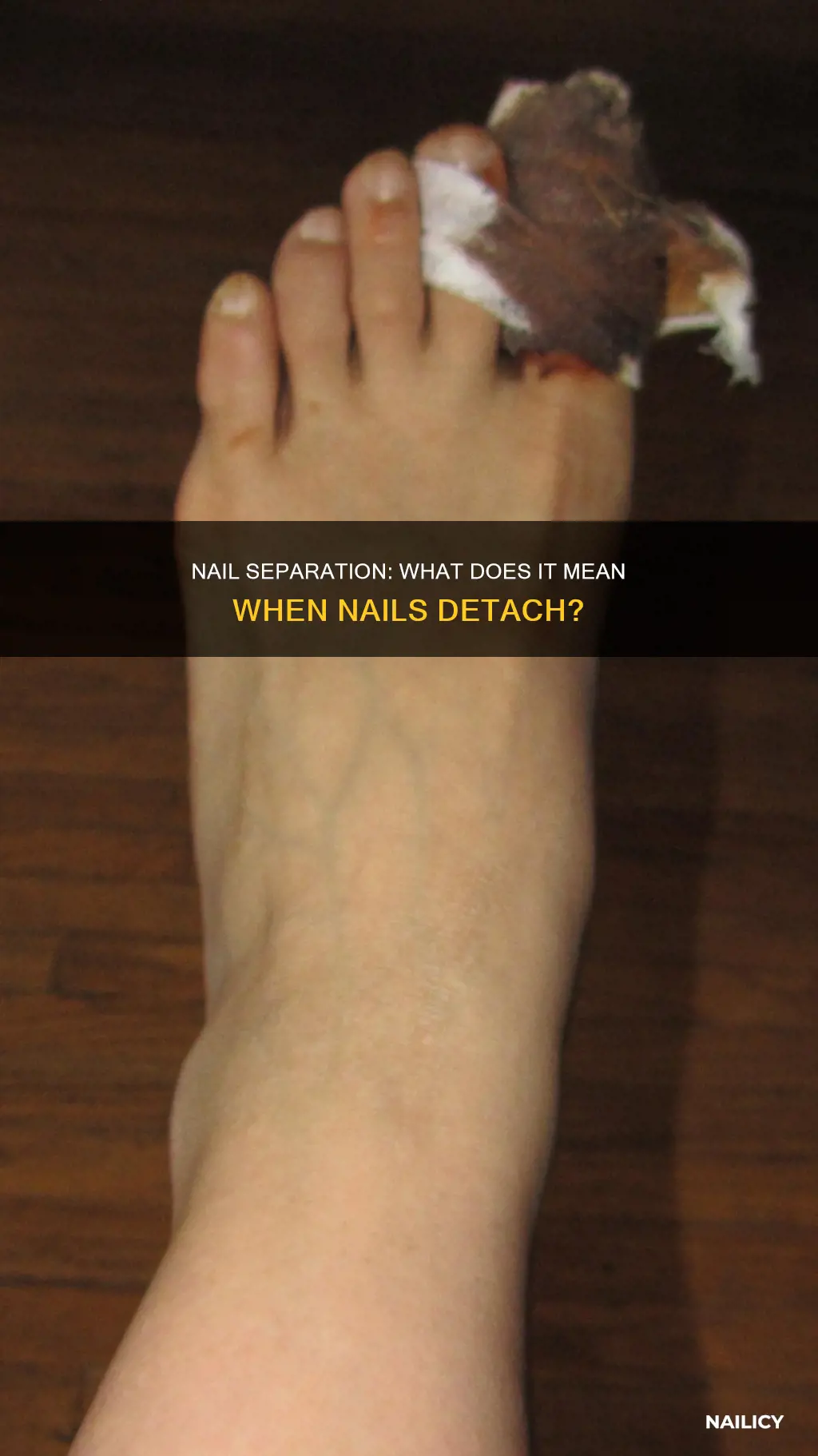 what does it mean when your nail comes off