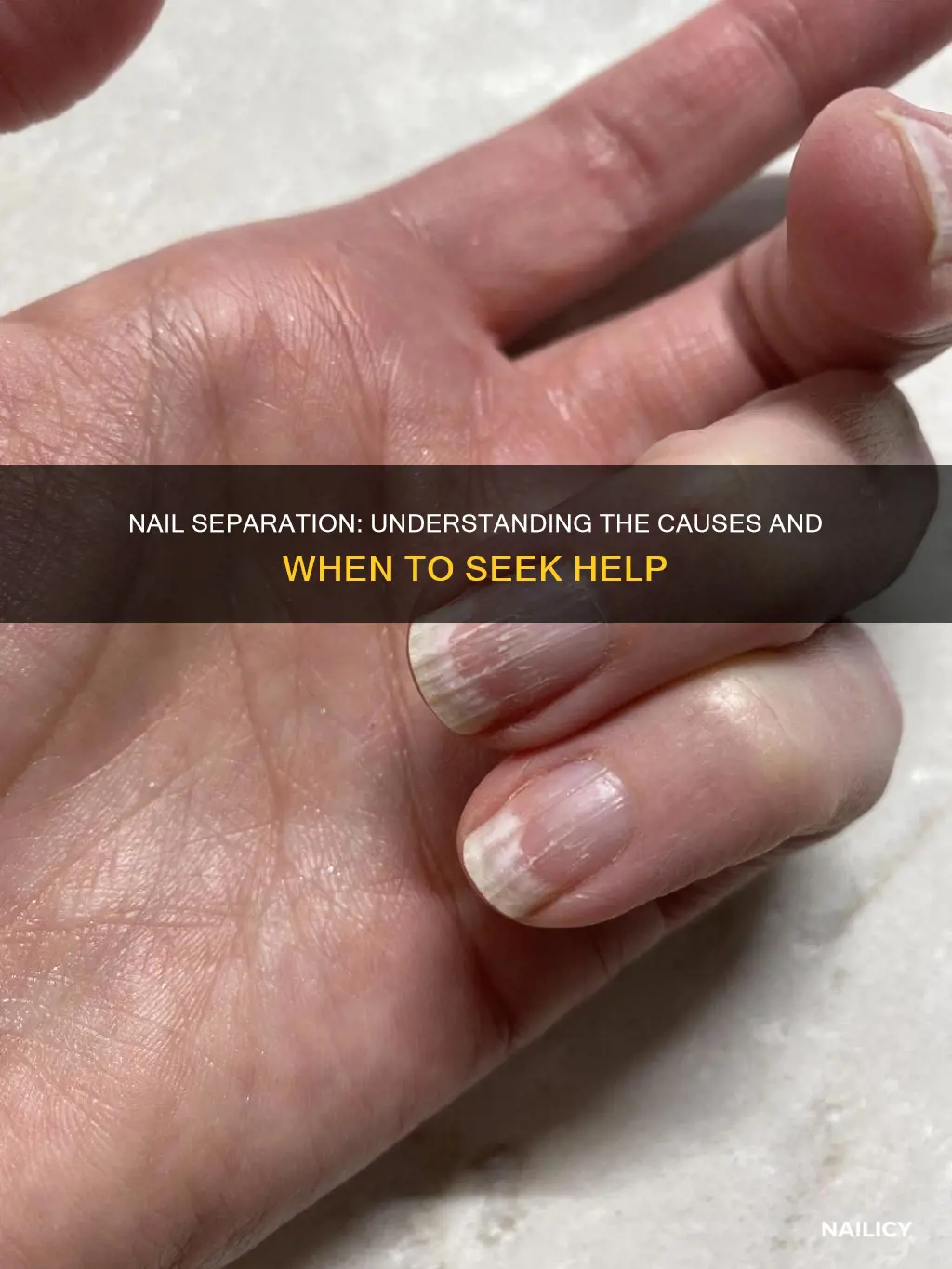 what does it mean when your nails separate