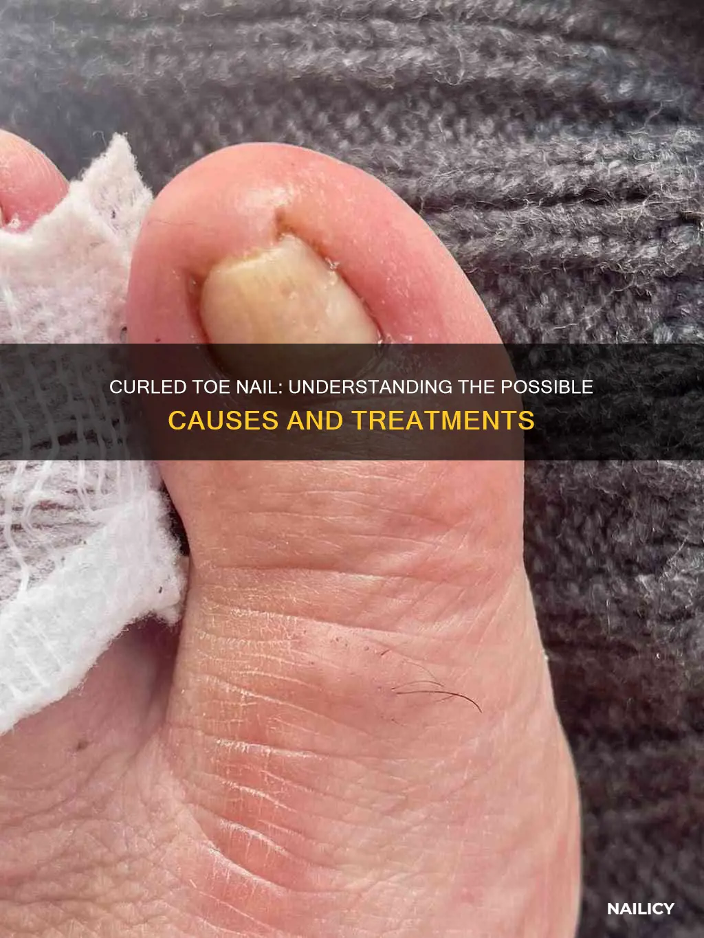 what does it mean when your toe nail curls in