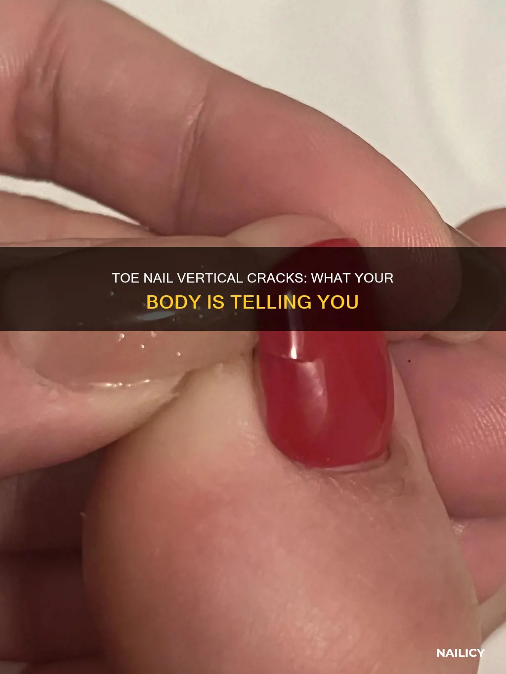 what does it mean when your toe nails cracks vertically