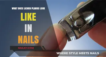 Lichen Planus Nail Symptoms: Appearance, Changes, and Identification Guide
