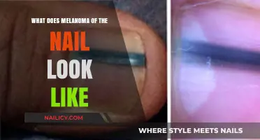 Identifying Melanoma Under Your Nails: Symptoms, Appearance, and Early Detection