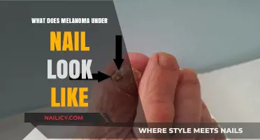 Recognizing Melanoma Under the Nail: Symptoms, Appearance, and Early Detection
